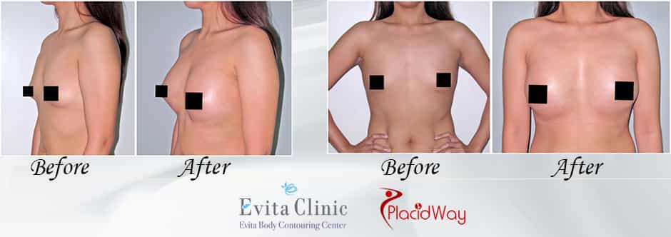 Know everything about breast augmentation surgery in Philippines at Medical City Clark Know everything about breast augmentation surgery in Philippines at Medical City Clark